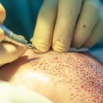 PRP Saç Tedavisi: Saçlarınıza Doğal Güç Katın