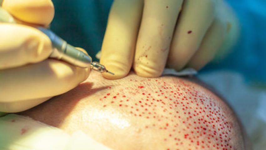 FUT Saç Ekimi - Hair Of Tatvan